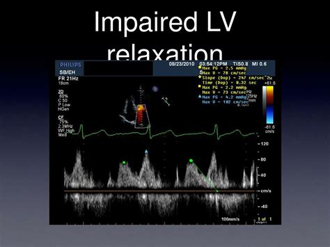 impaired left ventricular relaxation